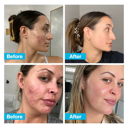 All In One CLEARSKIN™ 🍃